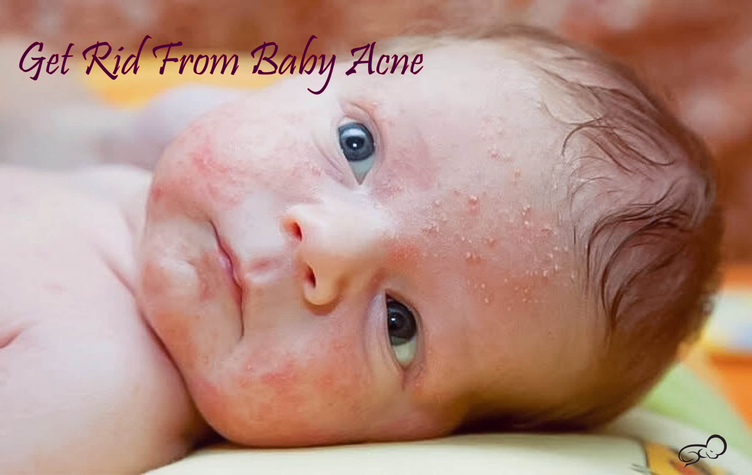 Baby Bumps On Face? How To Get Rid of Baby Acne